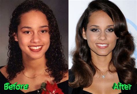 Alicia Keys Nose Job Surgery Procedure