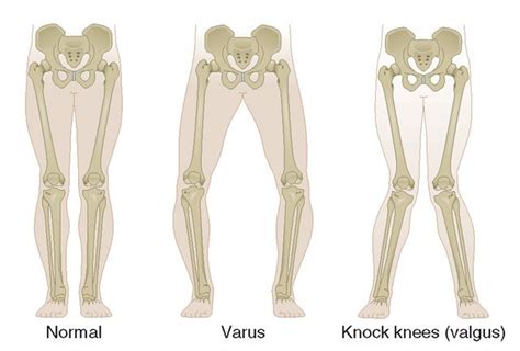 Knee Osteotomy - Sydney Knee Specialists