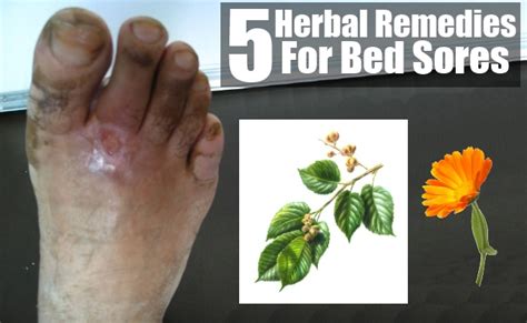 Bed Sores Herbal Remedies, Treatments And Cures | Natural Home Remedies ...