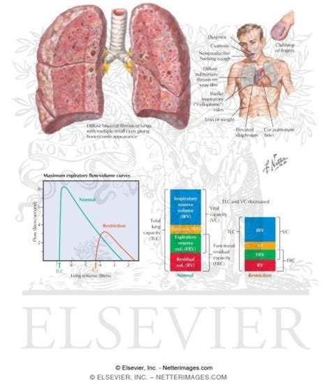 Idiopathic Diffuse Interstitial Pulmonary Fibrosis (Hamman-Rich Disease)