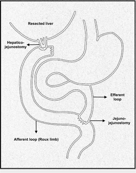 A sketch depicting a Roux-en-Y hepaticojejunostomy. | Download Scientific Diagram