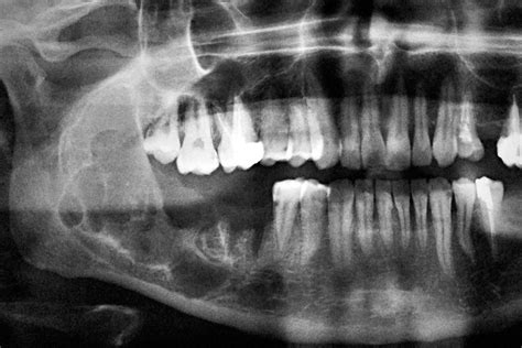 Ameloblastoma involving mandible | A rather big ameloblastom… | Flickr