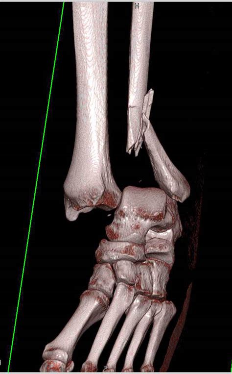 Fracture/Dislocation of the Ankle - Trauma Case Studies - CTisus CT ...