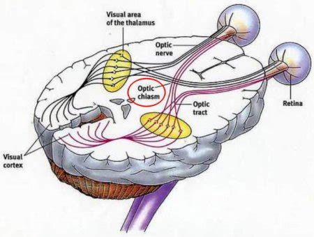 Congenitally absent optic chiasm: Making sense of visual pathways