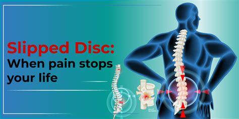 What is herniated disc or slipped disc? Know everything here