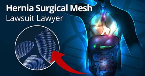 Hernia Surgical Mesh Lawsuit Lawyer | Attorney Jonathan Kline P.A.