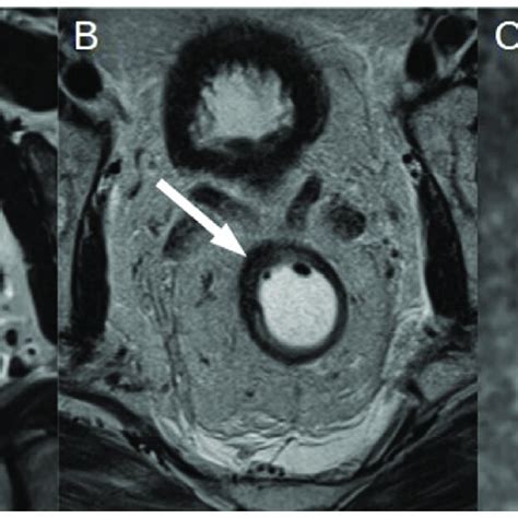 (A) T2-weighted axial oblique MRI of T3b rectal cancer (white ...