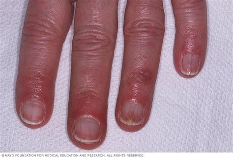 Chilblains Disease Reference Guide - Drugs.com