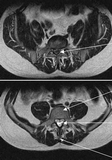 Cauda Equina Mri