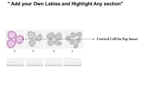 0814 Cervical Dysplasia Stages And Pap Smea Test Medical Images For Powerpoint | PowerPoint ...