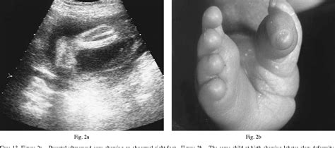 Figure 2 from Clinical outcome of congenital talipes equinovarus diagnosed antenatally by ...