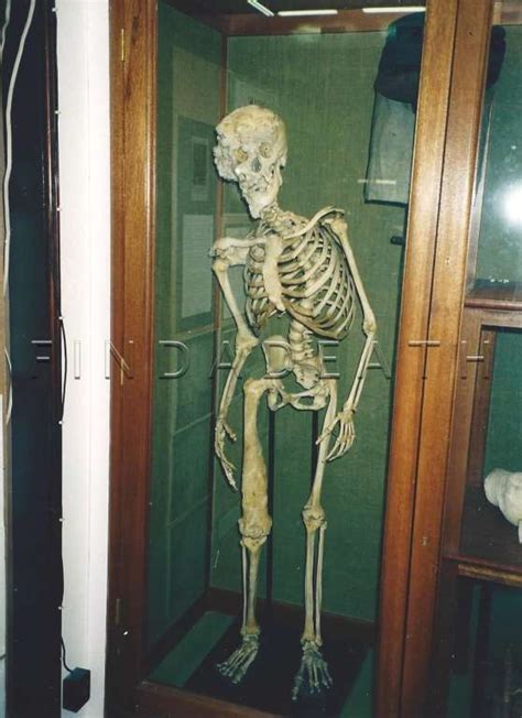 Joseph Merrick Skeleton