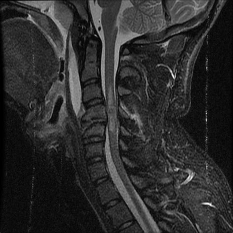 Spinal Cord Injury Mri