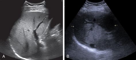 Abnormal Liver Ultrasound