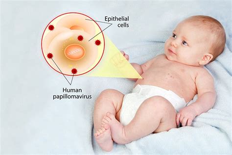 Warts In Babies: Types, Causes, Treatment, And Prevention | Baby, Warts ...