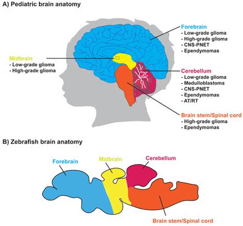 IJMS | Free Full-Text | Zebrafish Models of Paediatric Brain Tumours