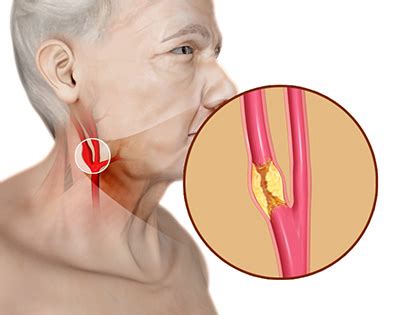 Carotid Artery Disease Treatment Sydney | CAD | Sydney