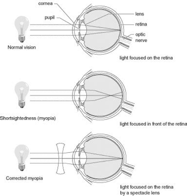 What is Myopia | Glasses Gallery | Eye care information