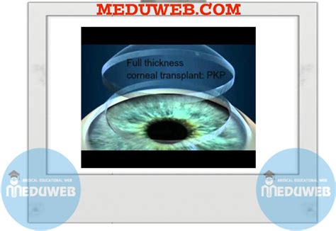 Clinical Notes on Penetrating keratoplasty (PKP) - Meduweb