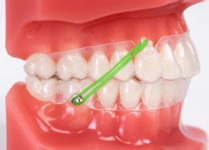 Clear Aligner and Class II Cross-elastics - Affinity Dental Care Burlington