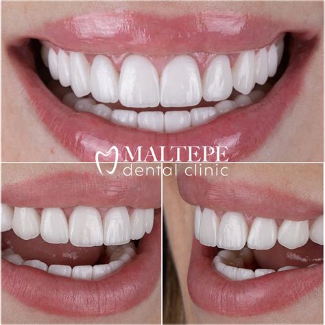 Perfect Teeth: What Can You Do To Have? - Maltepe Dental Clinic