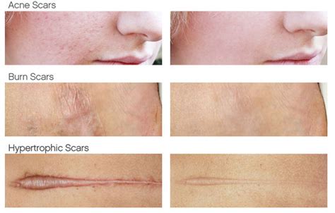 Dermafface FX7 Scar Removal Cream | Healthy Female