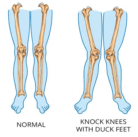 3 Steps to Eliminating Tensor Fasciae Latae Pain