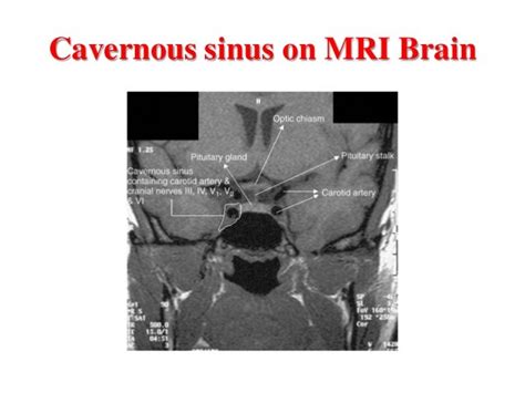 Cavernous sinus thrombosis.pdf ppt