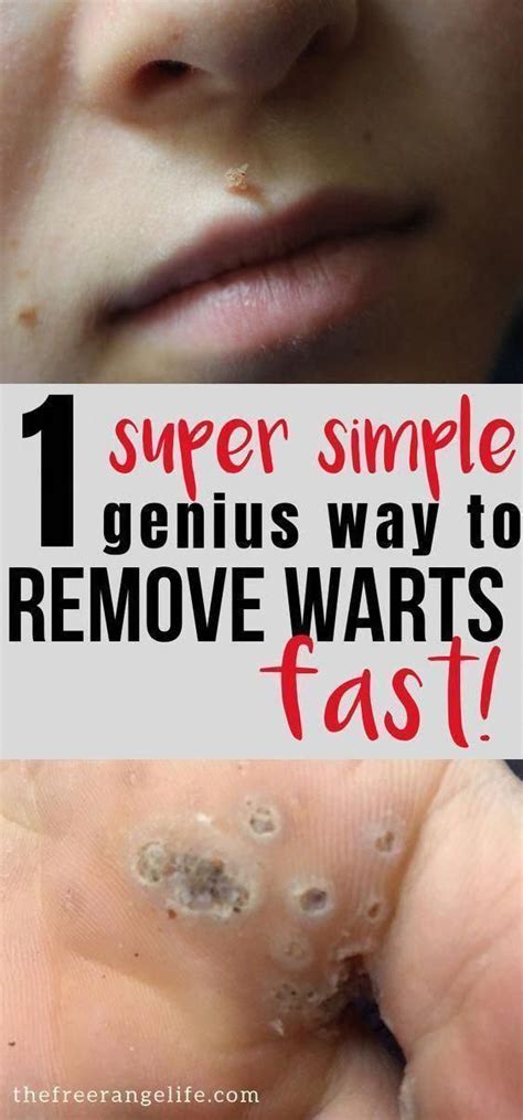 How To Remove Warts On Elbow - HOWTOREMVO