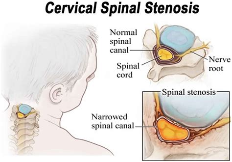 Neural foraminal stenosis causes, symptoms, diagnosis, treatment & prognosis