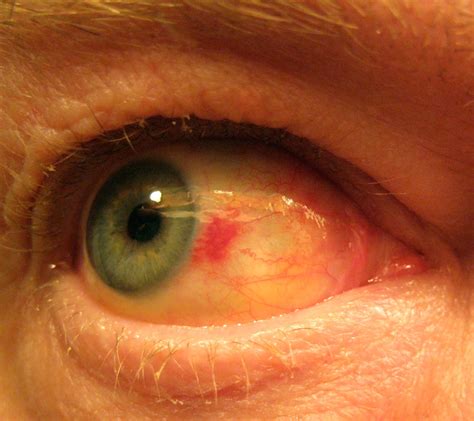 Random Walks: Subconjunctival Hemorrhage