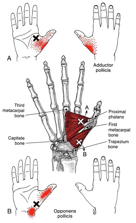 Opponens Pollicis | The Trigger Point & Referred Pain Guide