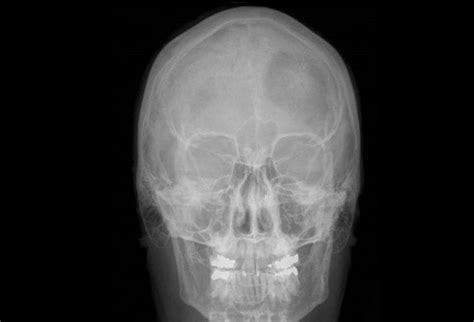 Meningioma: Characteristics and Treatment