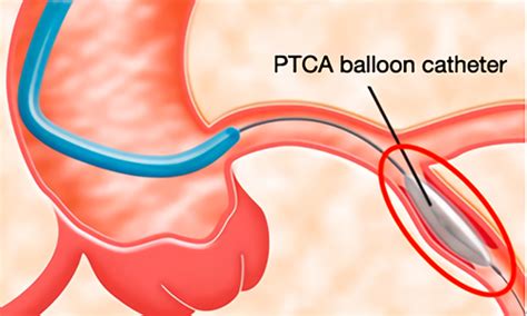 Asahi Intecc: What is catheter (PTCA) treatment?