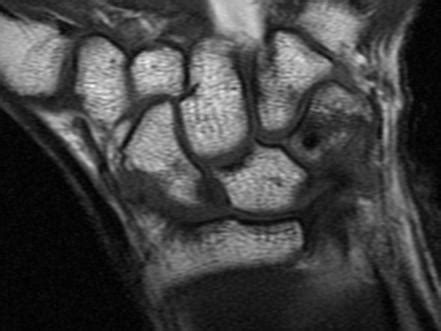 Triquetral fracture (MRI) | Radiology Case | Radiopaedia.org