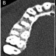 (PDF) Paramolar tubercle: A diversity in canal configuration identified ...