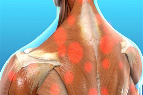 The impact of 8 weeks selected corrective exercises on neck pain, range of motion in the ...