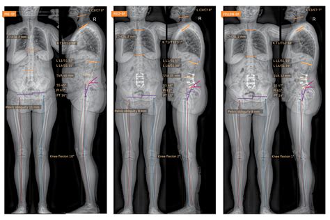 ATEC Spine EOS Imaging - ATEC Spine