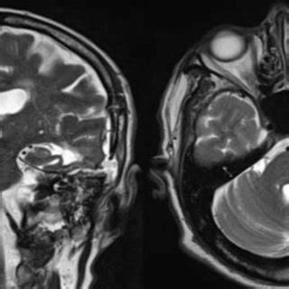 (PDF) Management of Spontaneous Cerebrospinal Fluid Leaks in the Middle Cranial Fossa and Bone ...