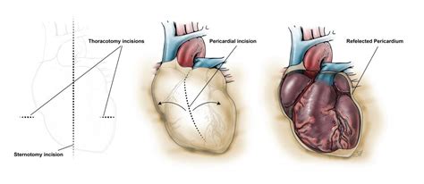 Pericardial Window Procedure Steps