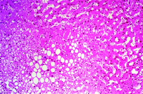 Hepatic Steatosis Histology