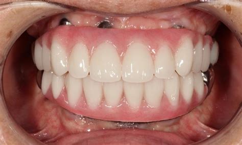 Hybrid Denture All-On-Four in Aurora CO | Before & After