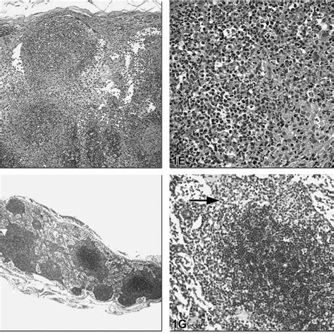 (PDF) Histopathology of the Lymph Nodes