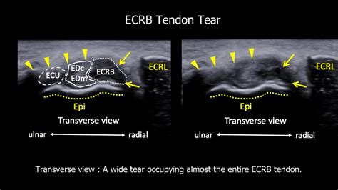 Adding a Transverse Scan in the Ultrasound Diagnosis of Extensor Tendinopathy - YouTube