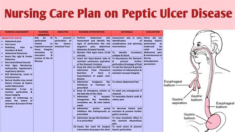 Peptic Ulcer Disease Nursing Care And Management Nurs - vrogue.co