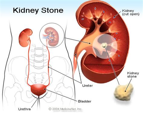 Renal calculi. Causes, symptoms, treatment Renal calculi