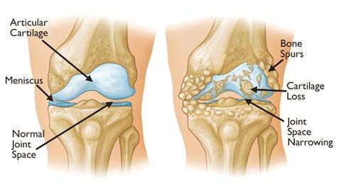 Knee Osteoarthritis - An Overview - Robert Howells