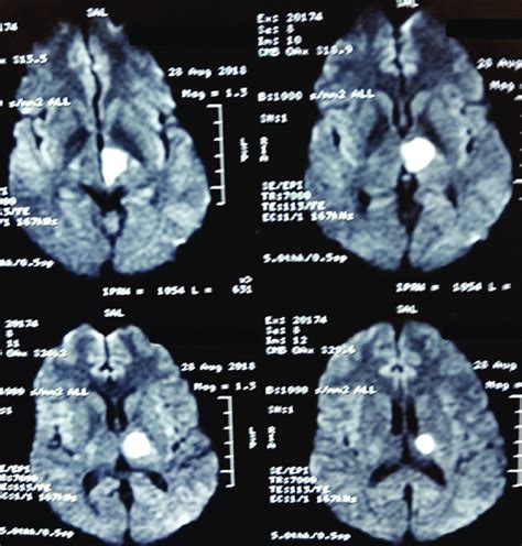 MRI Brain (DWI sequence) showing midbrain and thalamic infarct ...