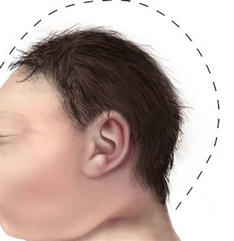 Microcephaly: Causes, symptoms, and treatment