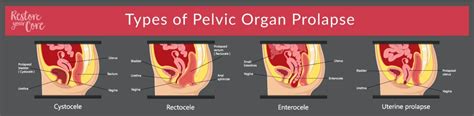 Restore Your Core Answers – Is Pelvic Floor Repair Major Surgery? | Syndiket Marketing | SEO ...